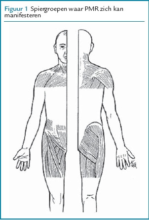 Polymyalgia Rheumatica En Arteriitis Temporalis Nhg Richtlijnen