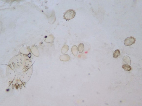 Volwassen scabiësmijt onder microscoop