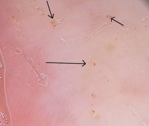 Dermatoscopie scabiës