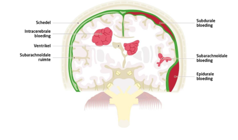 Soorten intracraniële bloedingen na een hoofdtrauma
