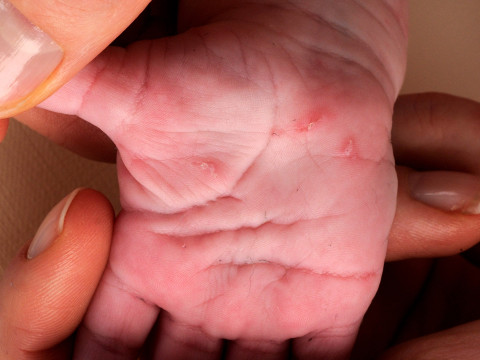 Hand met scabiës verschijnselen